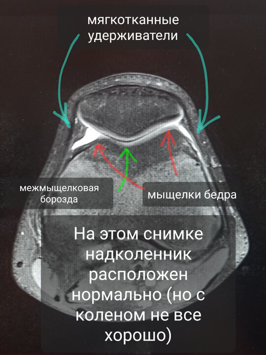 Вывих надколенника карта вызова