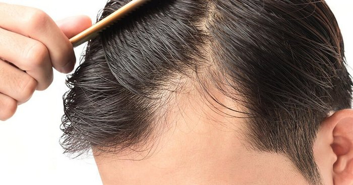 Диффузное выпадение волос | Пикабу