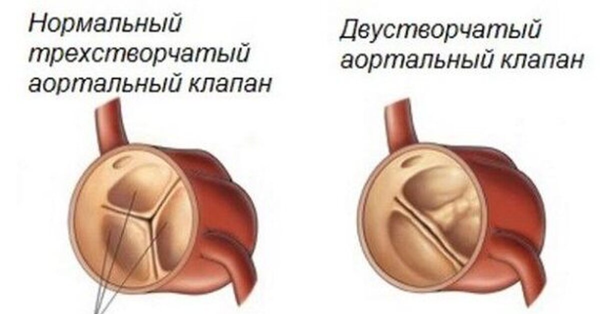 Двухстворчатый аортальный 1. ВПС двухстворчатый аортальный клапан. 2 Створчатый аортальный клапан у ребенка. ВПС 2х створчатый аортальный клапан. Функционально 2 створчатый аортальный клапан.