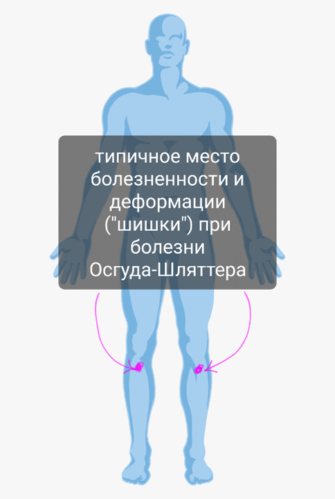 Болезнь Осгуда-Шляттера | Пикабу