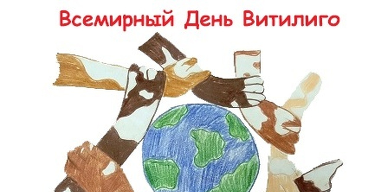 Всемирный день Витилиго | Пикабу