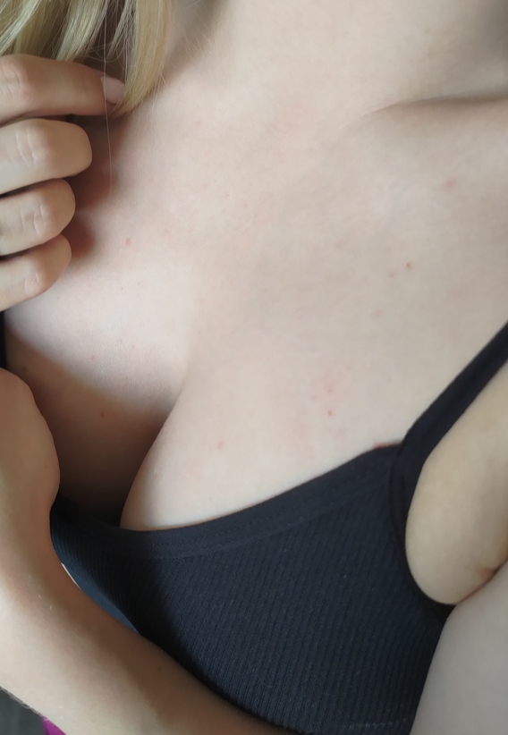 Увеличение груди имплантами в Саратове — от 70 ₽ за маммопластику