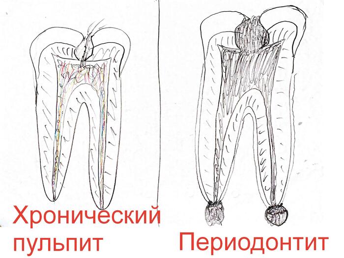 Сага о стоматологии. Глава 48. Что делать если сильно болит зуб ночью? Стоматология, Зубы, Боль, Стоматолог, Нервы, Врачи, Болезнь, Здоровье, Лечение, Лекарства, Поликлиника, Жизнь, Работа, Медицина, Россия, Нервная система, Пульпит, Больница, Вопрос, Зубная боль, Длиннопост