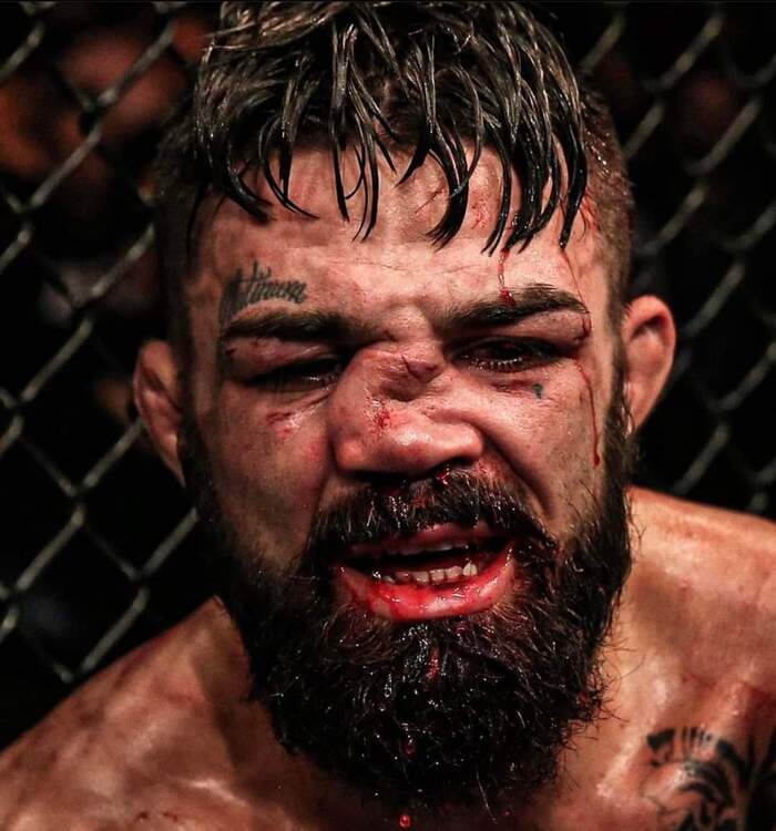 Ринопластика