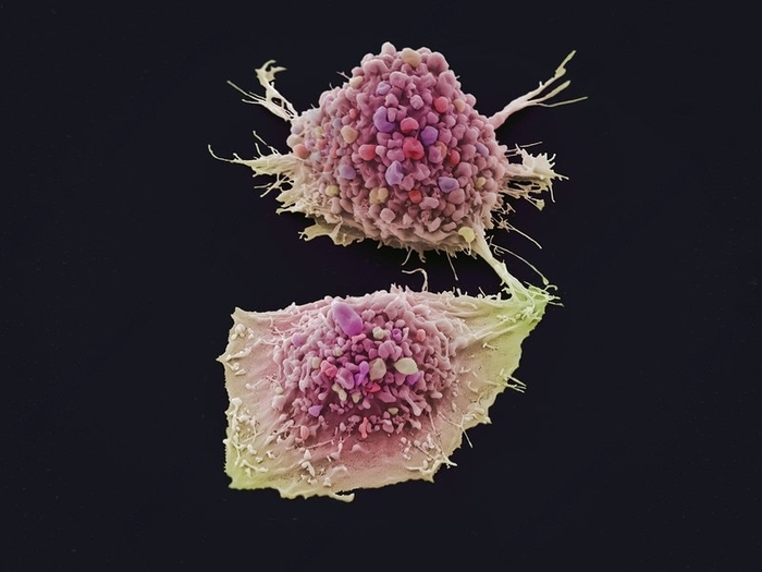 Раковая клетка лёгких. Увеличение: x3000 раз. Сканирующий электронный микроскоп.