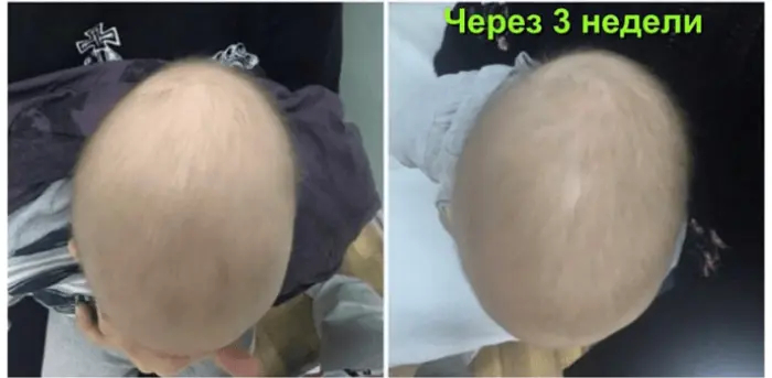 Первый ортопедический шлем в России для детей с деформацией головы | Пикабу