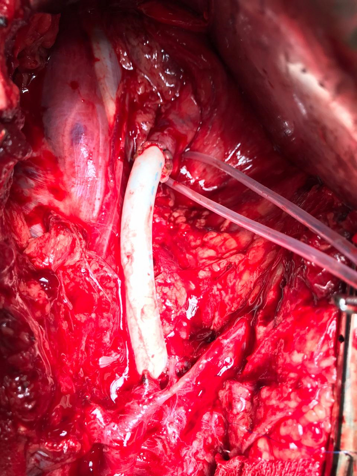 Беленькая штучка - это искусственный сосуд. Но можно использовать и собственную вену, если она по размеру подходит))