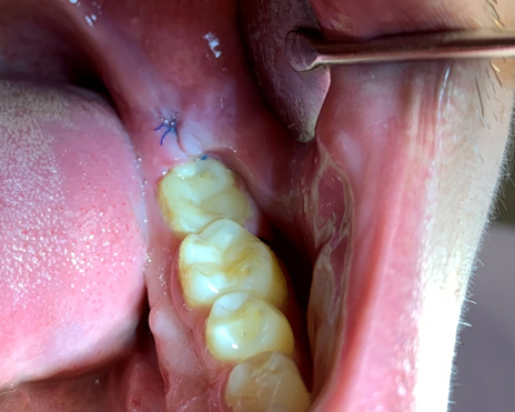 Нужно ли наращивание костной ткани после удаления зуба?
