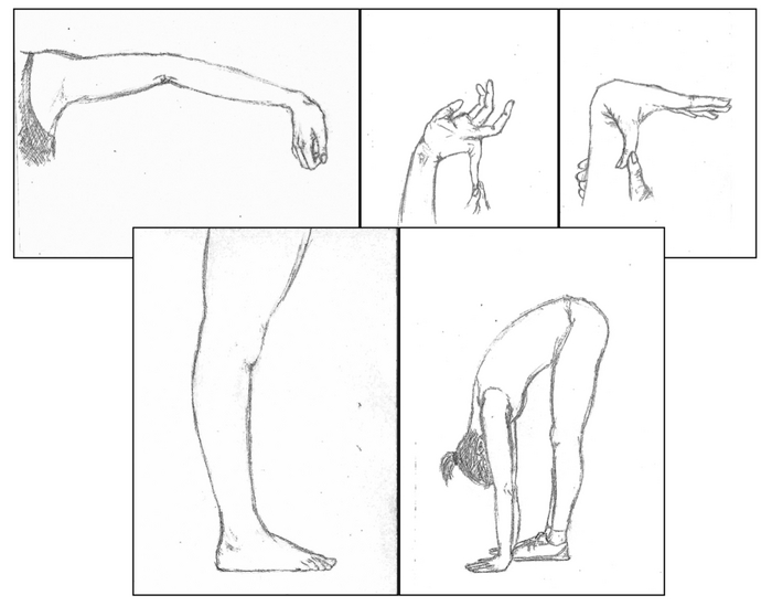 Гипермобильность суставов при синдроме Элерса — Данлоса
Aleksandra Lacheta / Wikimedia Commons