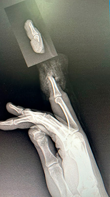 Двум девочкам в Москве оторвало пальцы декоративными кольцами. Врачи Филатовской детской больницы вовремя реплантировали их