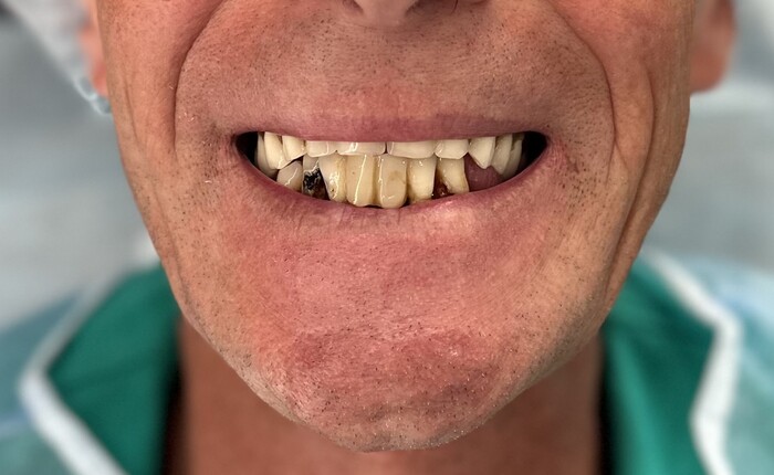 Зубы для бомжа блоггера Жени Якута - краудфандинговый проект на Boomstarter
