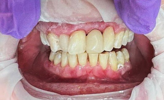 Зуб 2.1 (резец центральный левый) - имитация. Доктор после финишной полировки зубов сразу сделал фото для себя, для контроля. Не думал, что я этот материал загребу себе.