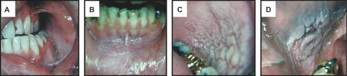 Рисунок 2 | Кератоз, вызванный употреблением жевательного табака (бездымный табачный кератоз)