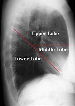Upper Lobe   , Middle Lobe   , Lower Lobe   