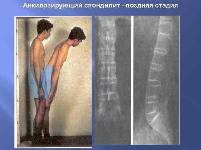 Анкилоз позвоночника - срастание позвонков между собой.