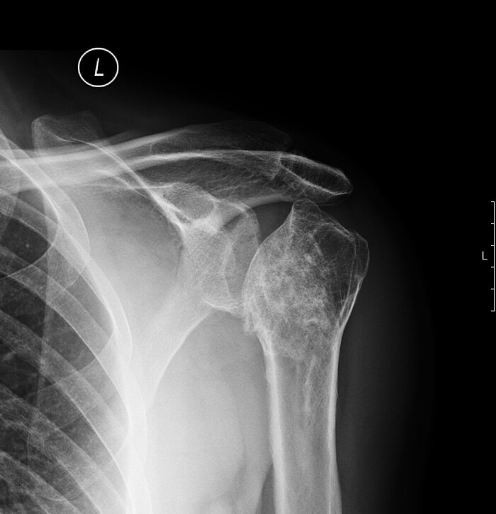 Некроз и деформация головки плеча.