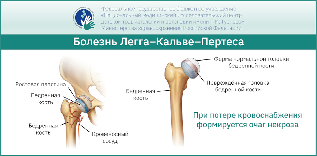 Болезни тазобедренного сустава у детей. Некроз головки бедренной кости. Болезнь Пертеса.. Стадии болезни Пертеса головки бедренной кости. Асептический некроз головки бедренной кости Пертеса.