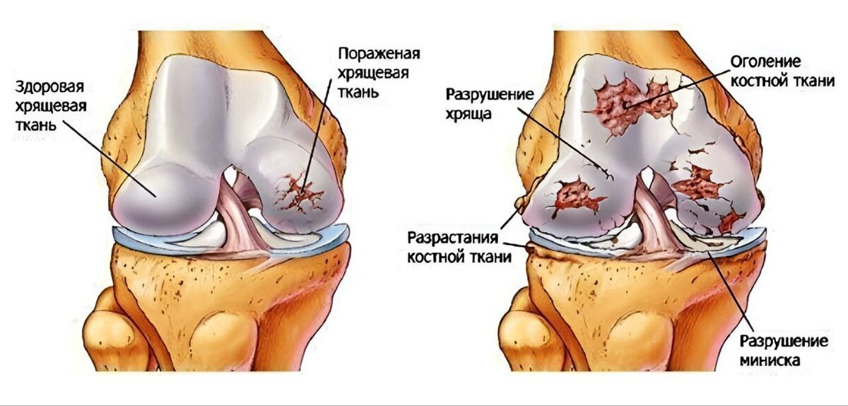 Деформирующий артроз сустава. Разрушение хряща коленного сустава. Разрушение хрящевой ткани коленного сустава. Деформирующий артроз коленного сустава схема. Хрящ коленного сустава артроз.