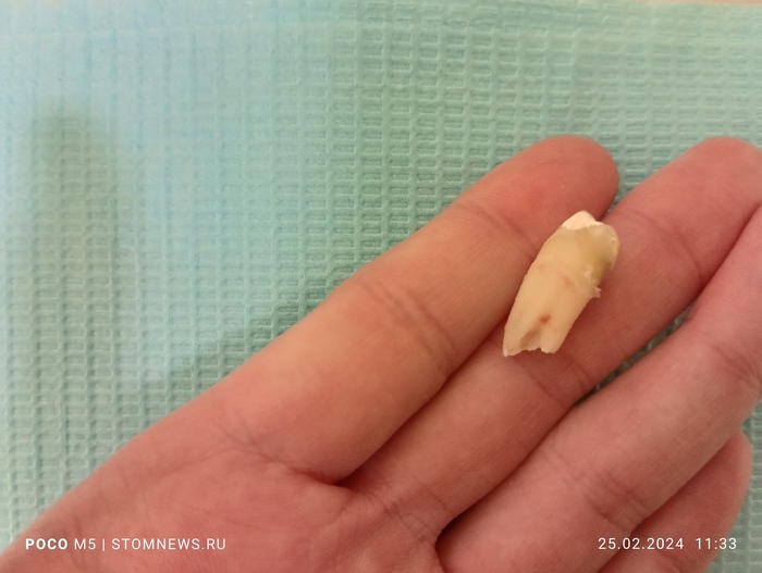 Удаленный моляр 4.5 с плавниковым типом корней Медицина, Стоматология, Зубы, Зубная фея