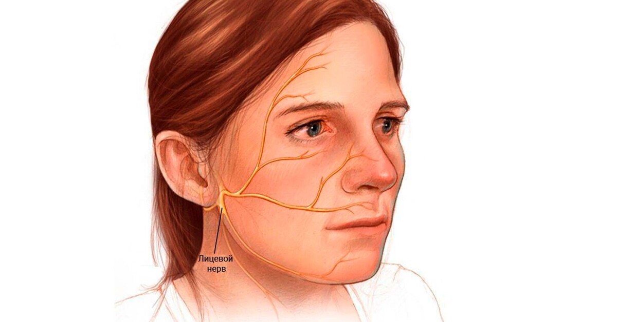 Нефрит лицевого нерва