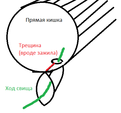 Анальная трещина - диагностика и лечение в медицинском центре в Москве