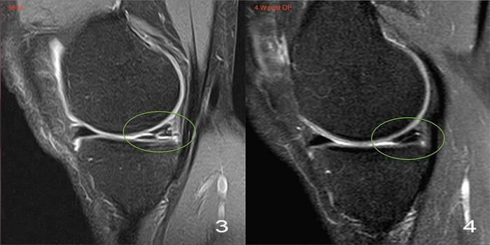 Разрыв заднего рога медиального мениска.