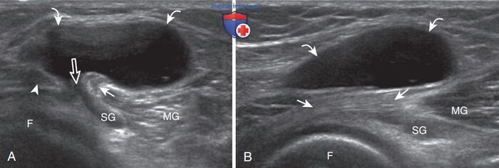 Киста Бейкера на УЗИ.