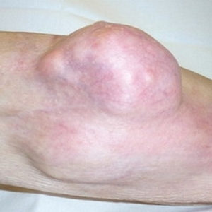 Саркома коленного сустава.