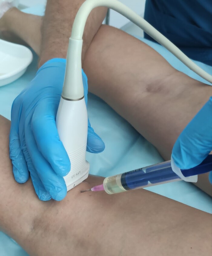 Пункция кисты под УЗ-контролем.