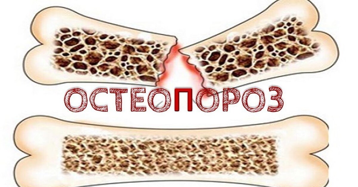 Остеопороз стопы что это. Остеопороз стопы что это. Показатели остеопороза. Ломкость костей. Профилактика остеопороза.