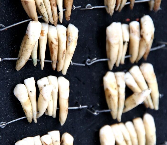 «Зубы Ватерлоо» продавались на рынке стоматологических материалов связками