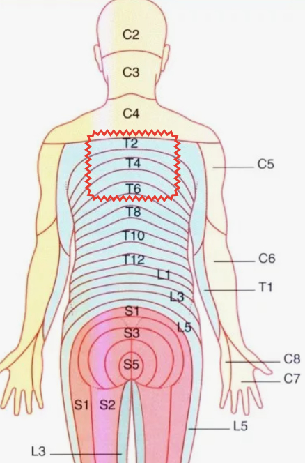 Наиболее частая локализация в зоне иннервации спинномозговых нервов сегментов Т2-Т6
