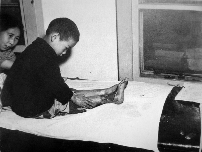 Трехлетний мальчик, получивший ожог ноги во время американской бомбардировки Токио. 1945 год.