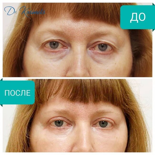 Как уменьшить морщины под глазами