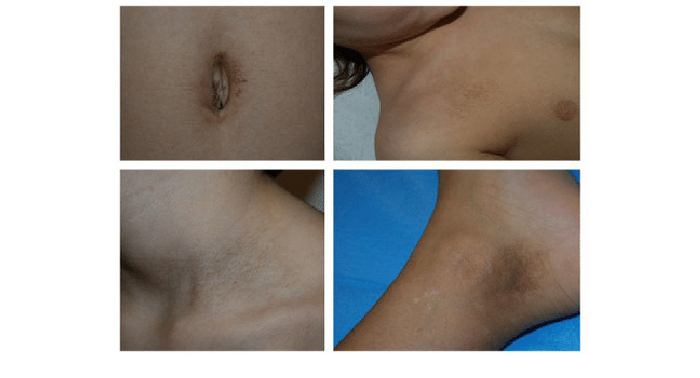 Когда грязная шея - диагноз