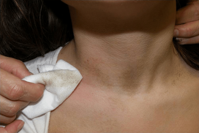 Когда грязная шея - диагноз