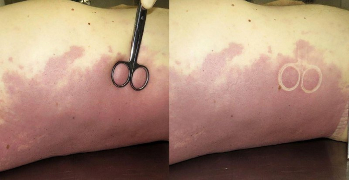 На этом фото, например, трупные пятна появились на спине и, скорее всего, на бедрах, что говорит нам о том, что он умер в положении лёжа