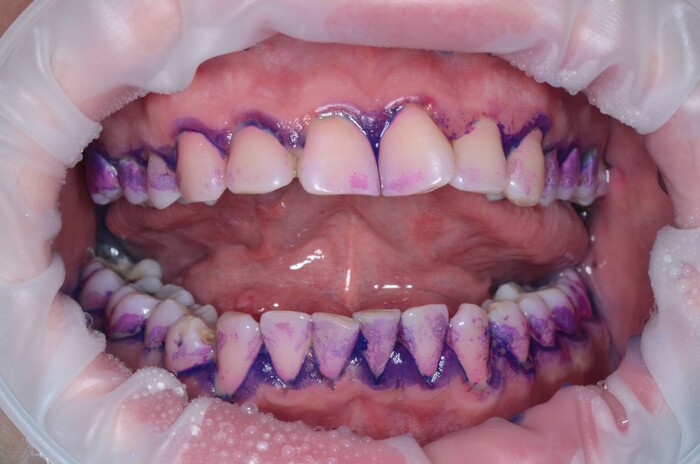 На фото после смытия индикатора окрашенными остался налет и камни на зубах.