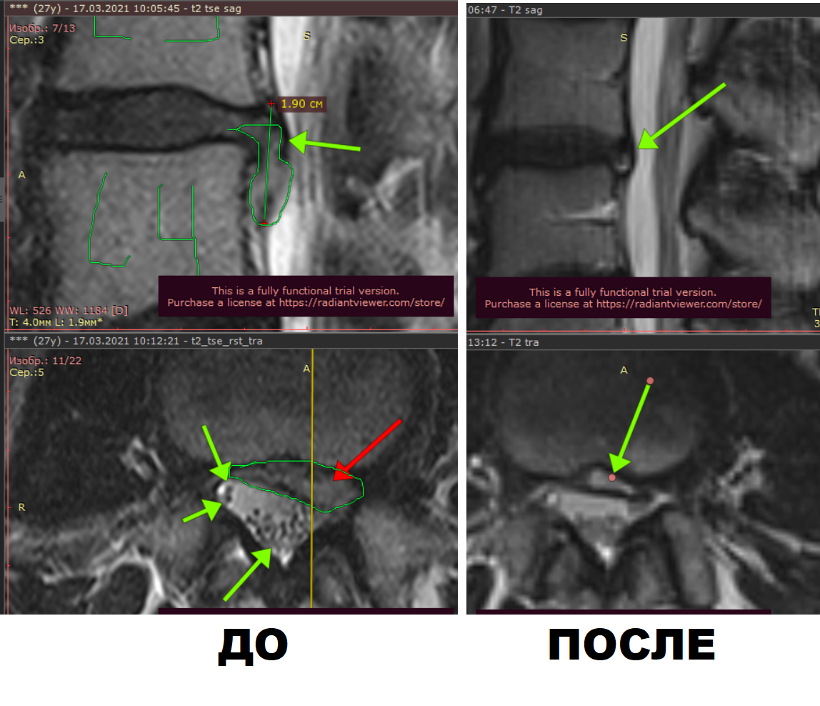 Полностью вылечили грыжу диска L3-L4. Детальный разбор МРТ от невролога для  пациентов | Пикабу