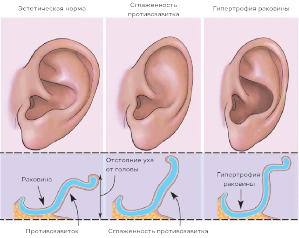Отопластика - коррекция ушей | Пикабу