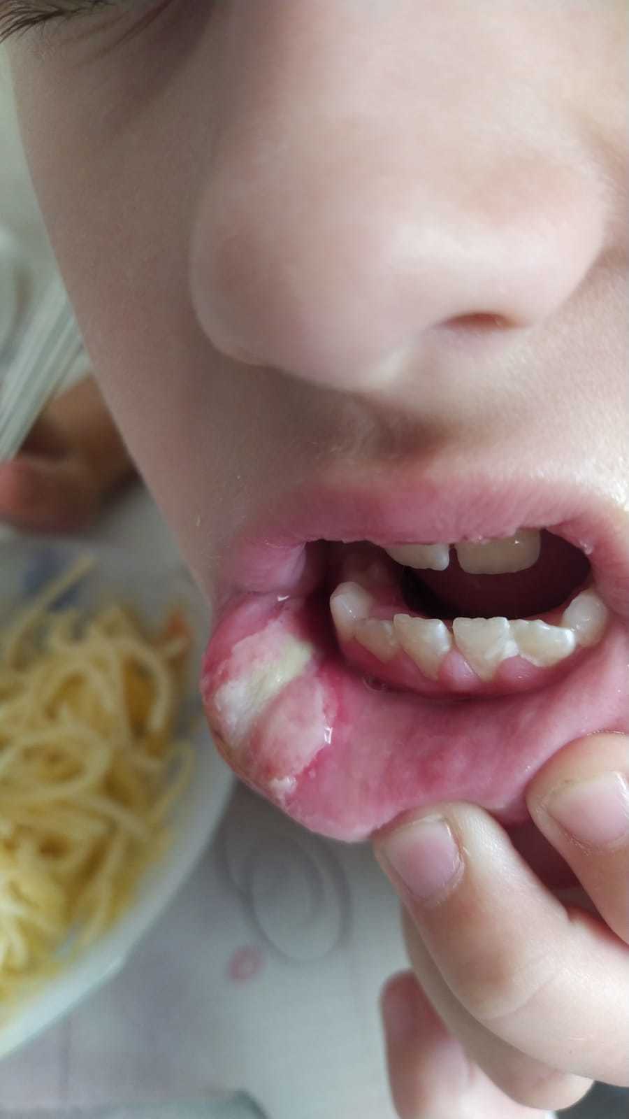 Осложнение после лечения зубов у детей: накусывание мягких тканей