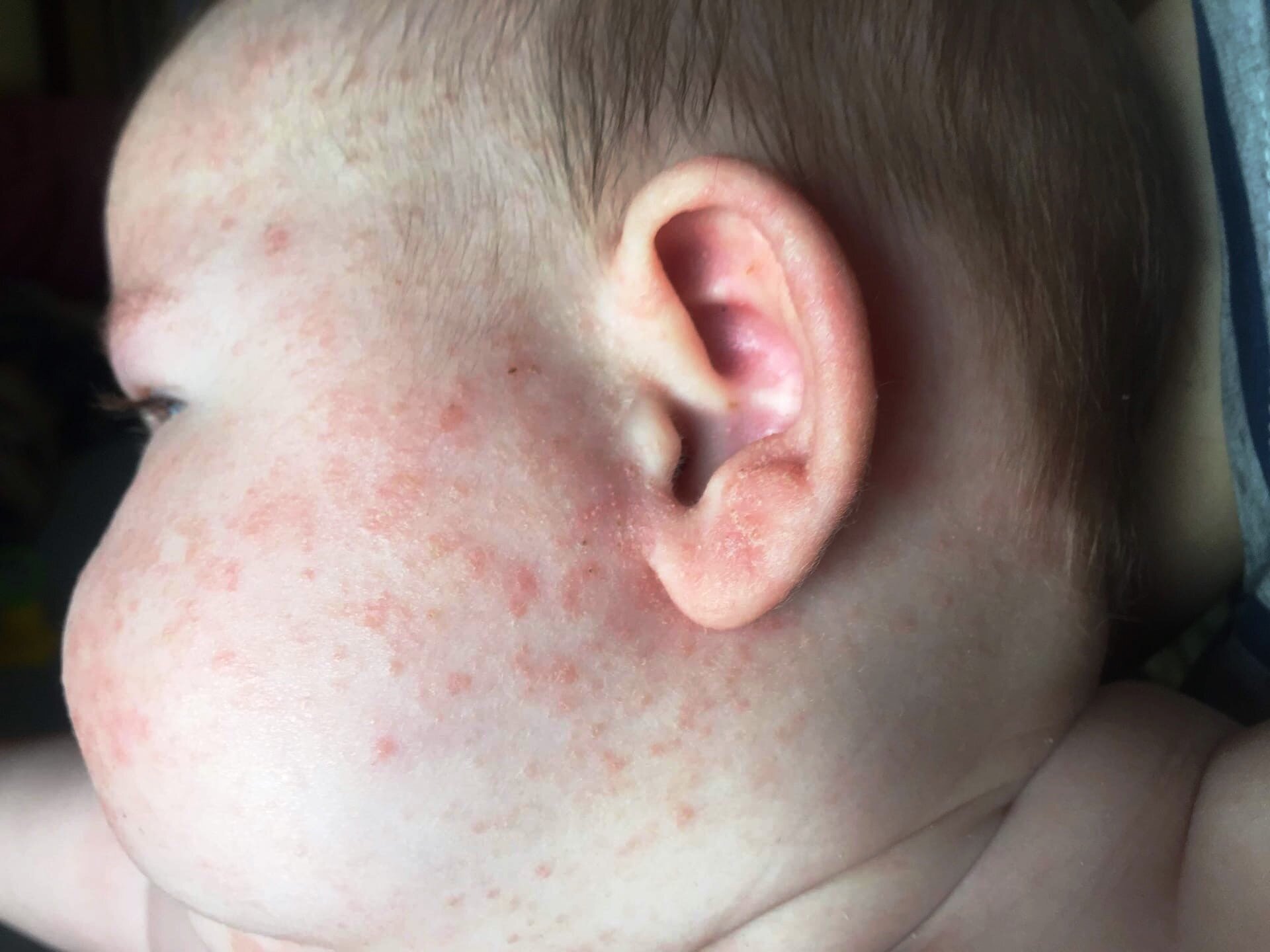 У ребенка резко появилась аллергия на молоко. Почему такое может быть?
