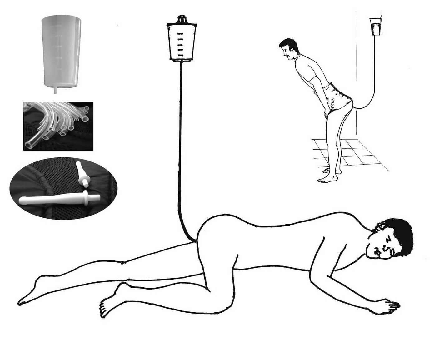Упражнения для простаты для мужчин: гимнастика при простатите и аденоме предстательной железы