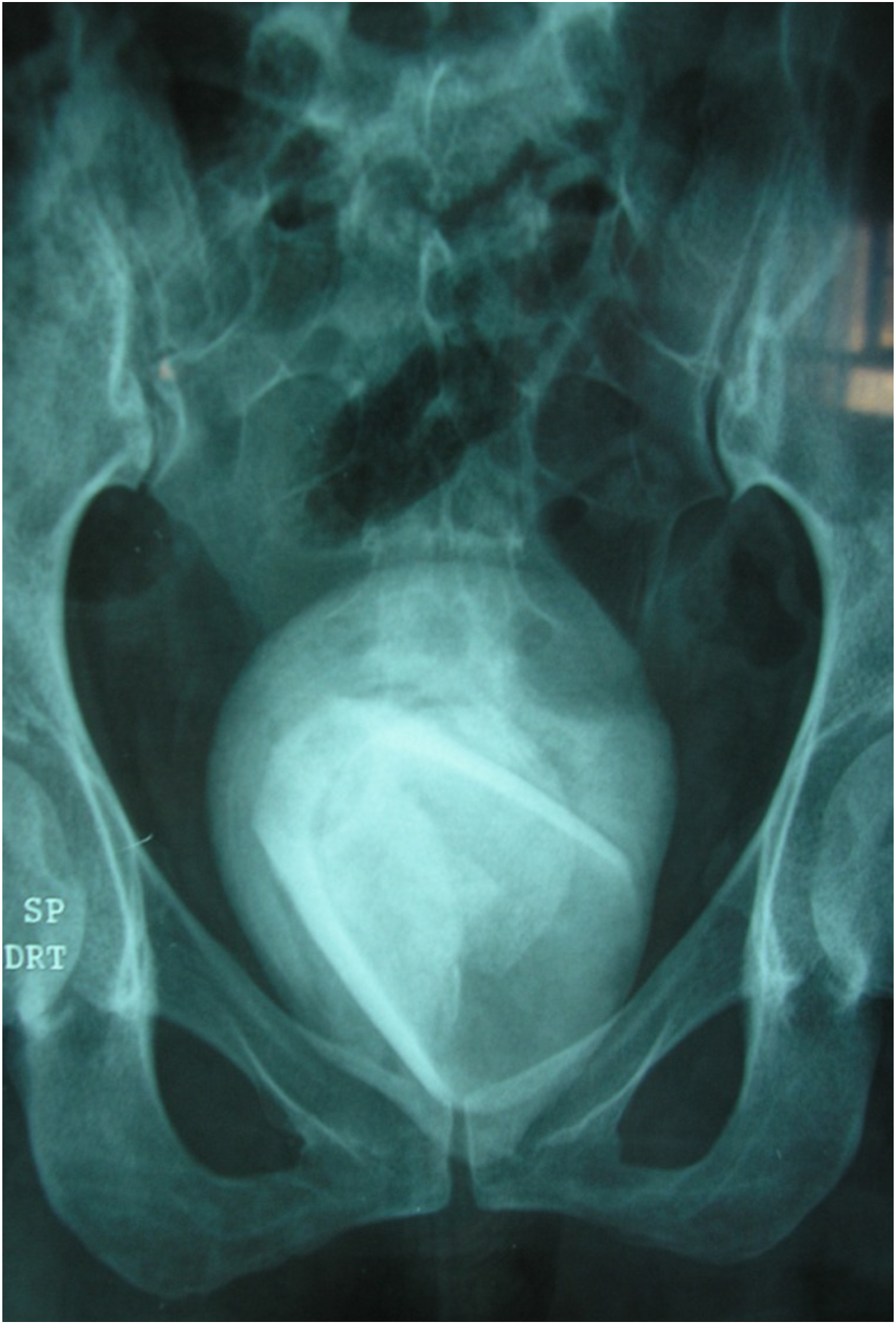Рентген таза у мужчин и женщин: подготовка, что показывает, особенности