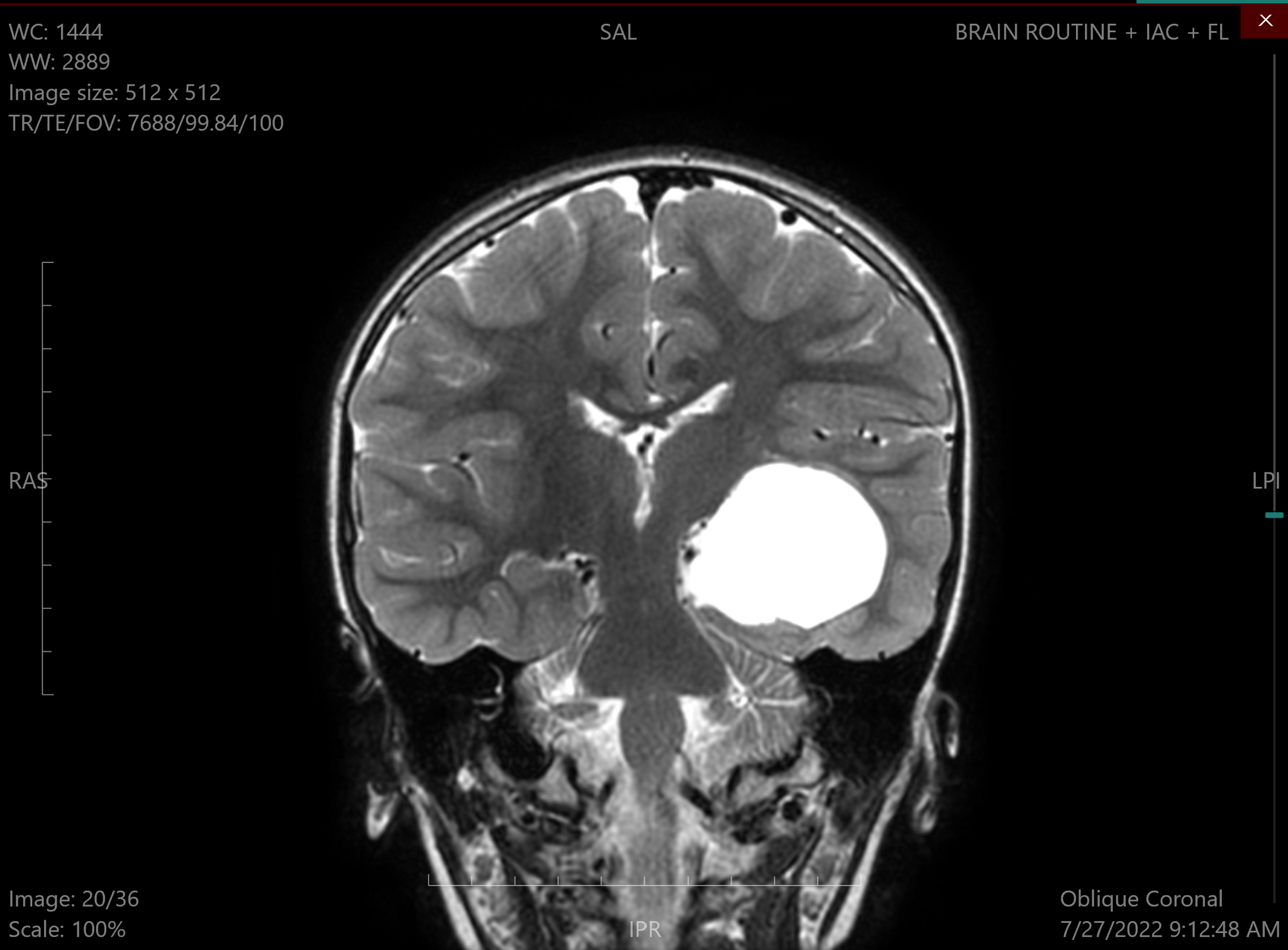 Множественные кисты в головном мозге. Киста головного мозга армия