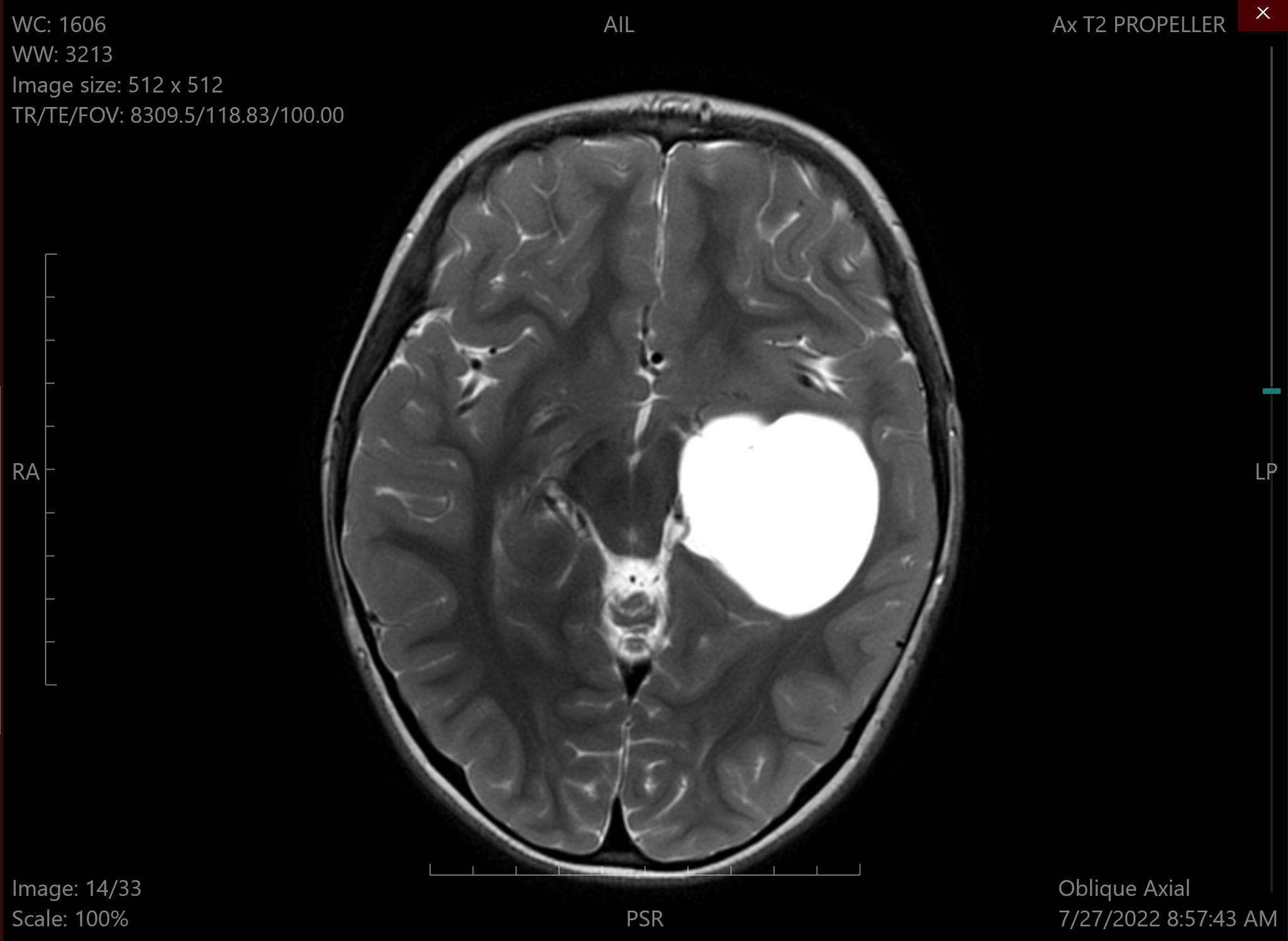 Киста головного мозга ребенка | Пикабу