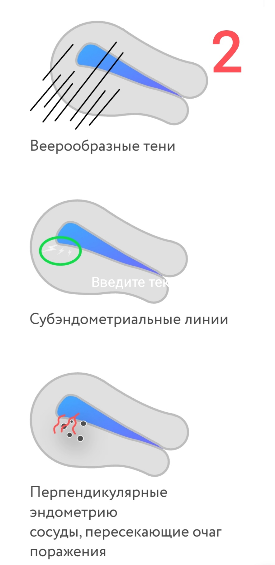 Аденомиоз или нет? | Пикабу