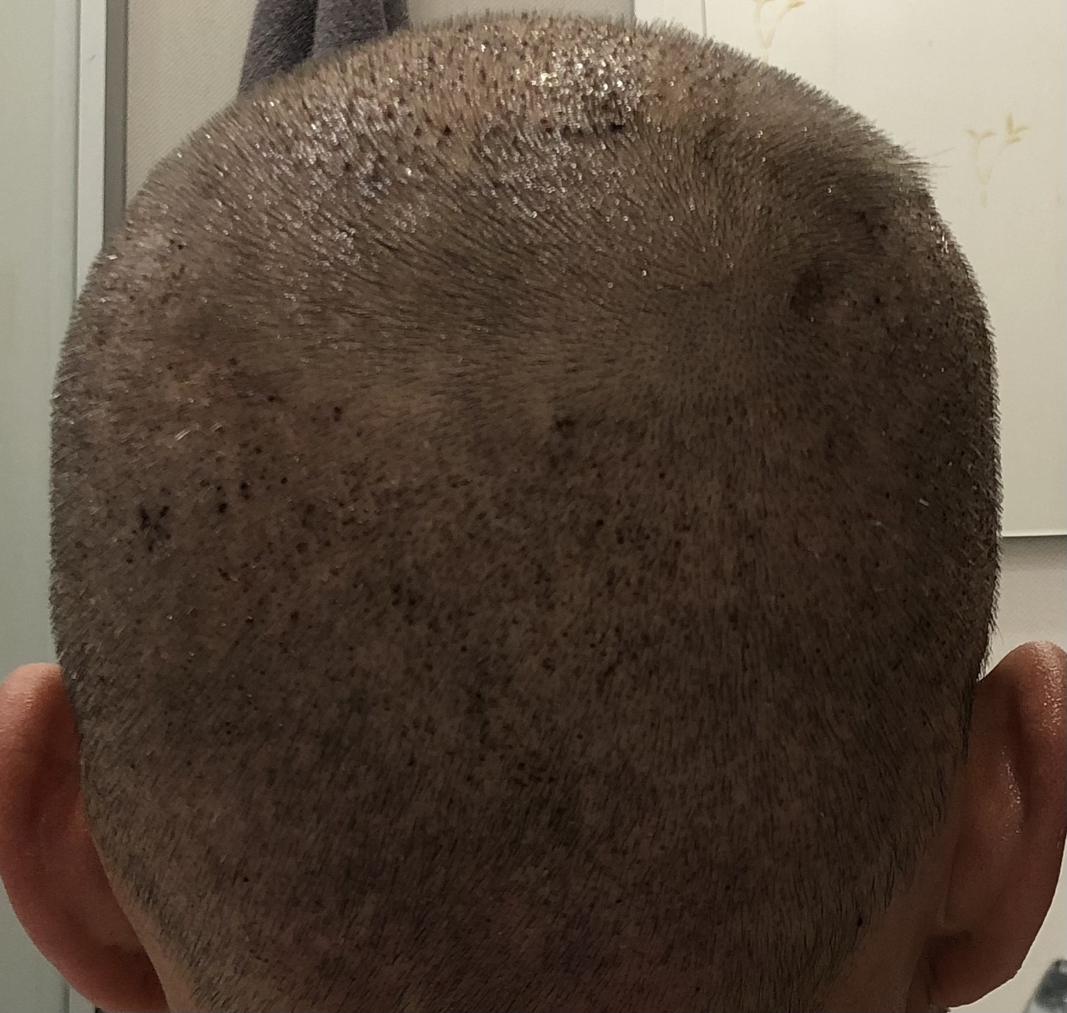 4 Месяца после пересадки волос