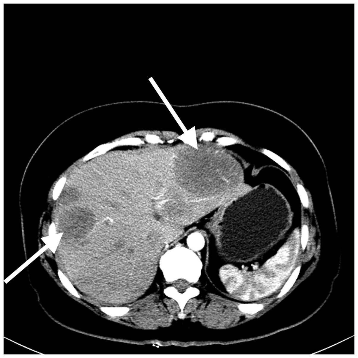 Метастазы в печени. Возможные варианты лечения | Пикабу