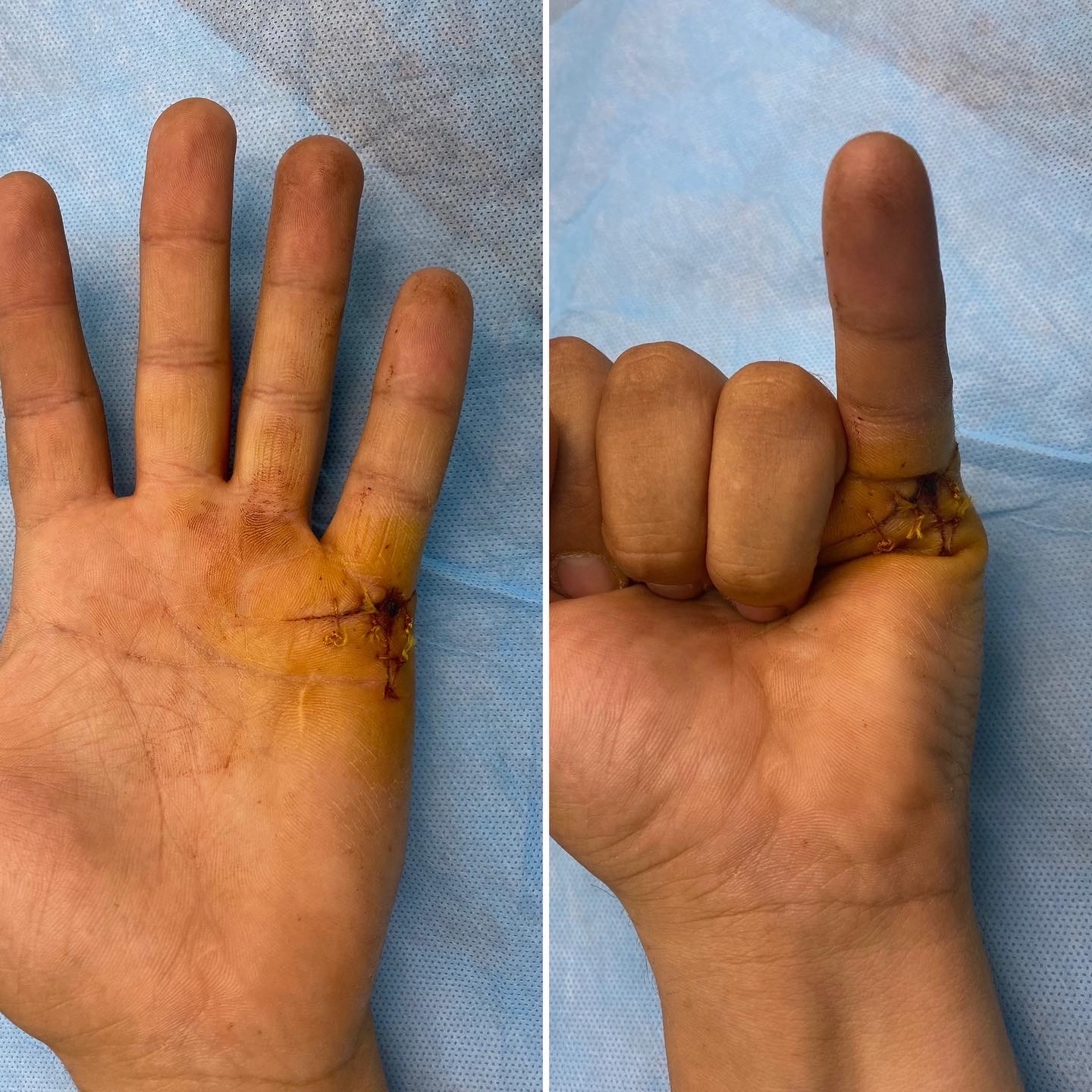 Если немеют пальцы на руках: причины, лечение и профилактика